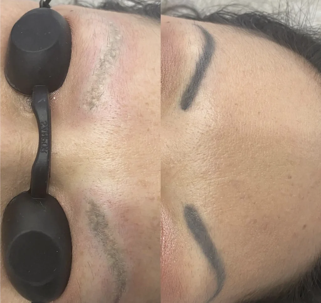 brow tattoo removal