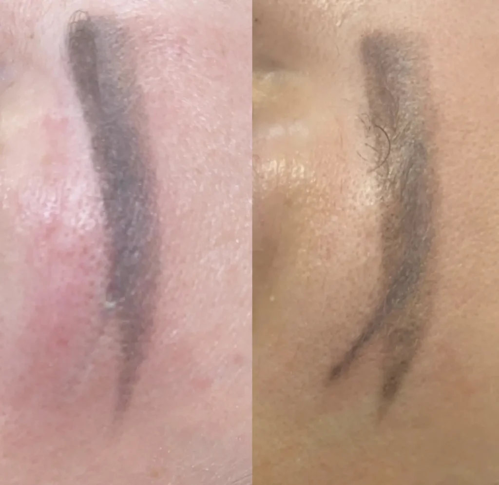 cosmetic eyebrow tattoo removal