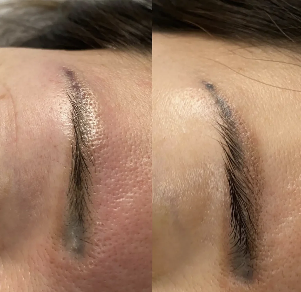 eyebrow laser tattoo removal