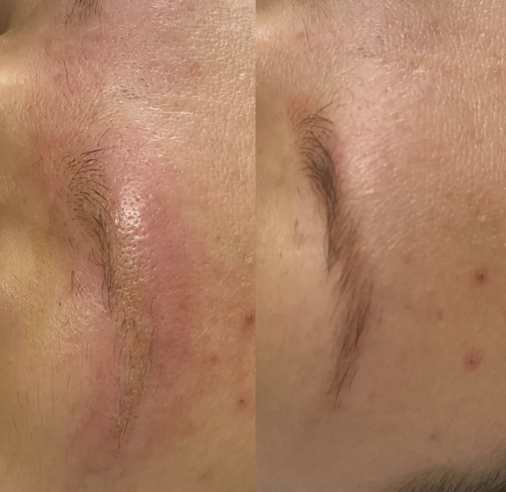 eyebrow tattoo laser removal