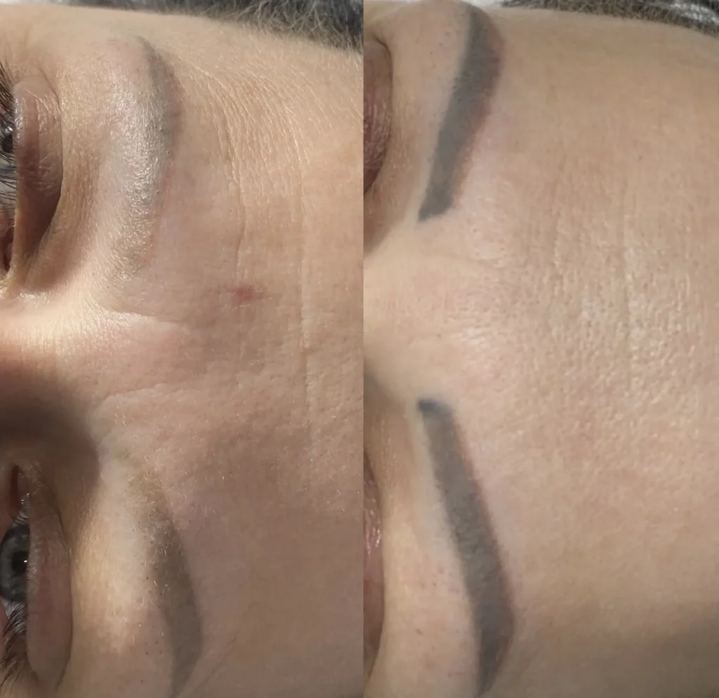 eyebrow tattoo laser removal before and after