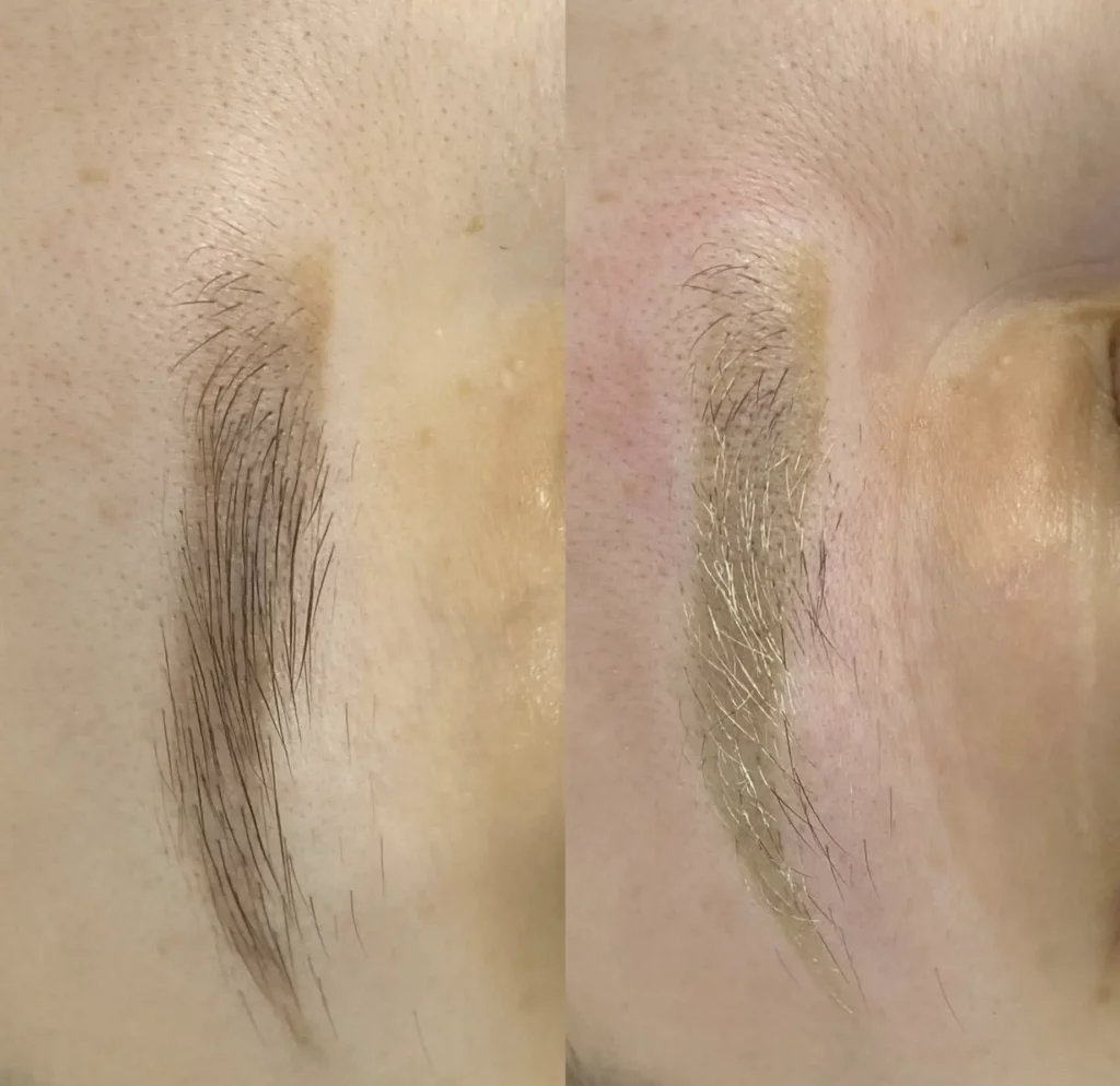 eyebrow tattoo removal