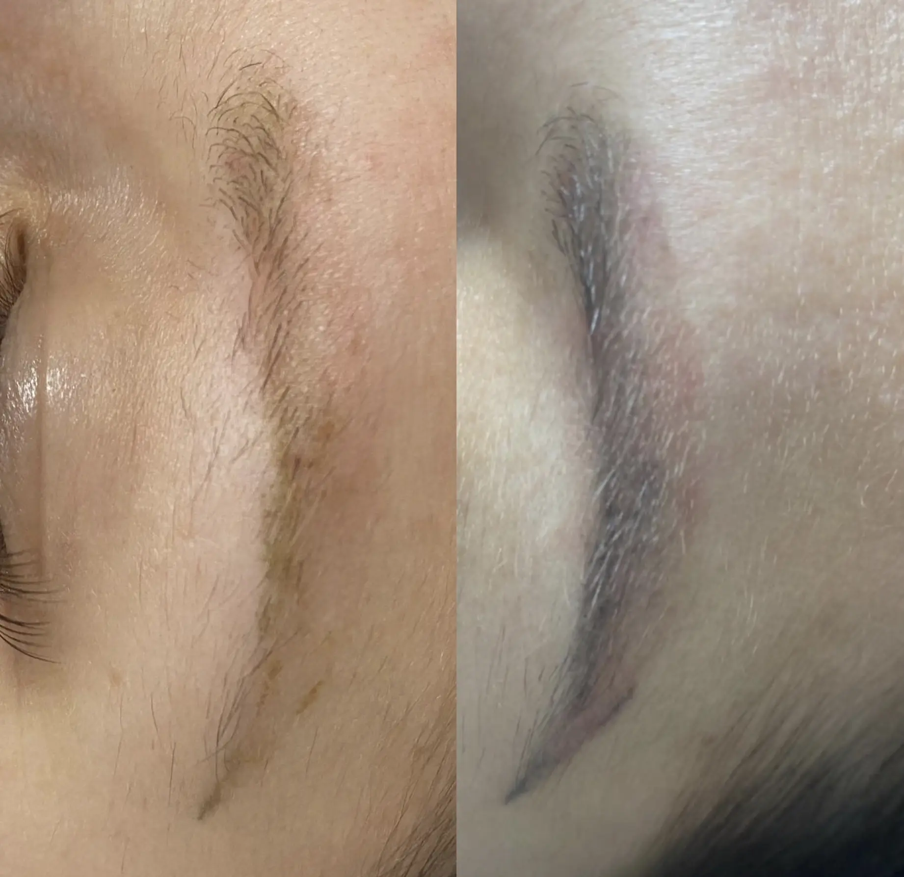 eyebrow tattoo removal melbourne