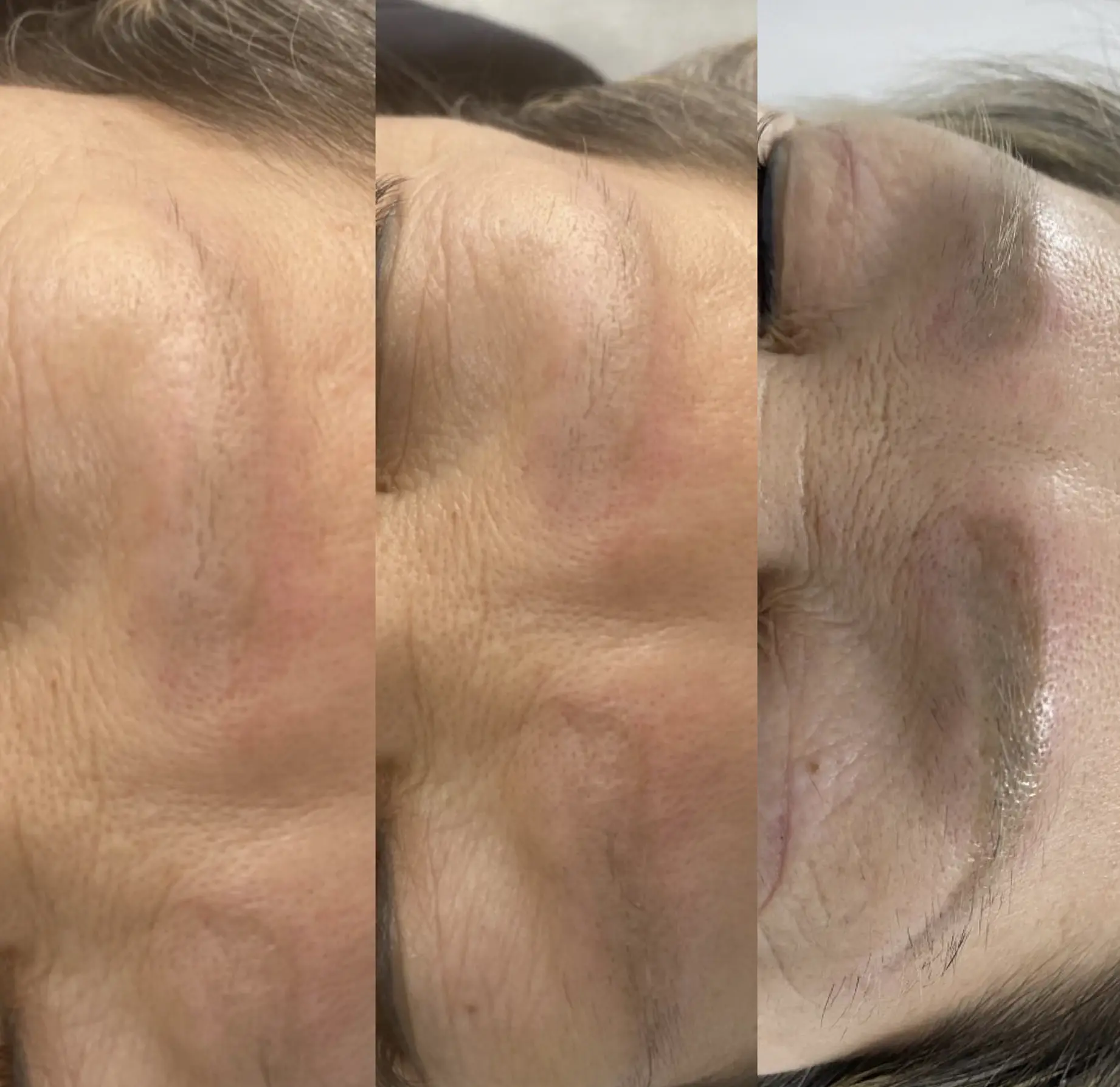 eyebrow tattoo removal near me