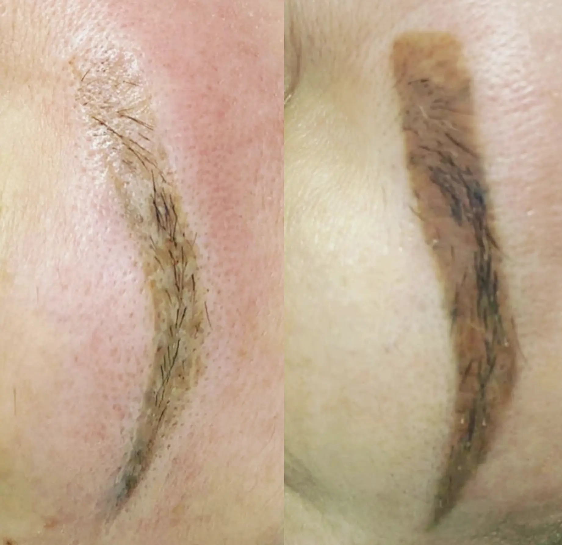 laser eyebrow tattoo removal before and after