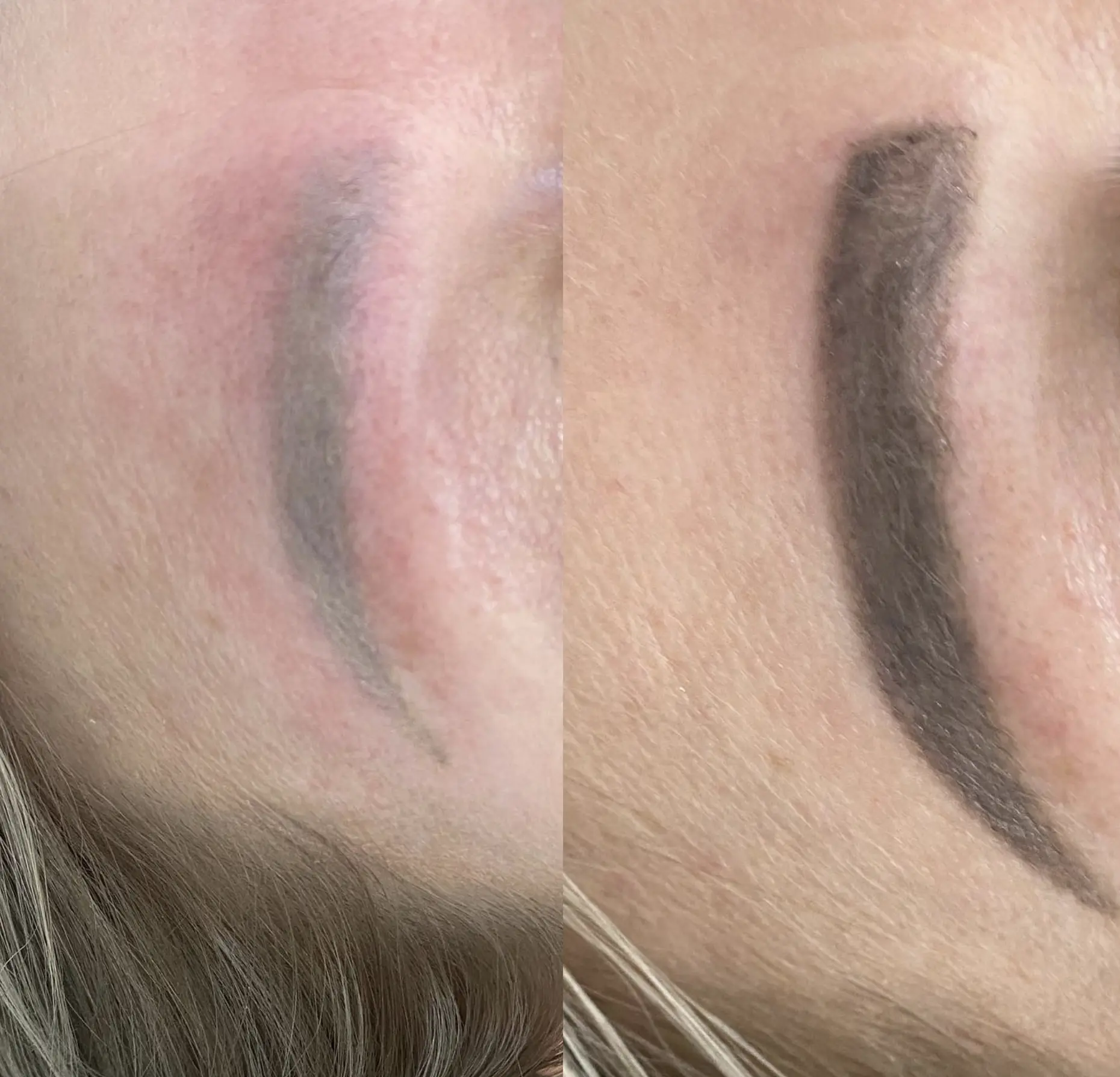 laser eyebrow tattoo removal