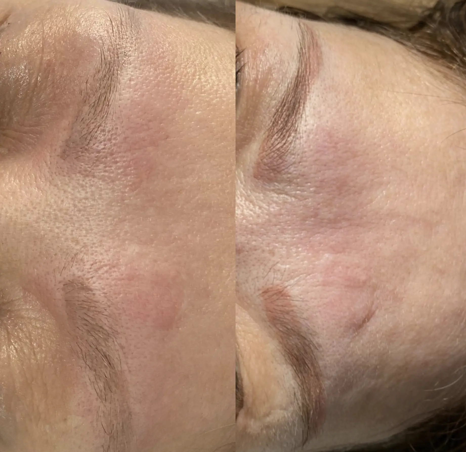 laser tattoo removal eyebrows